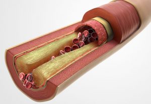 Atherosclerosis-Triglycerides-cause-stroke