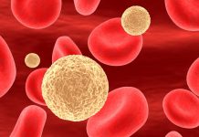 Hyperlipidemia: Causes, Symptoms and Treatment Hyperlipidemia: Causes, Symptoms and Treatment