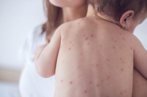 measles-spot-on-children