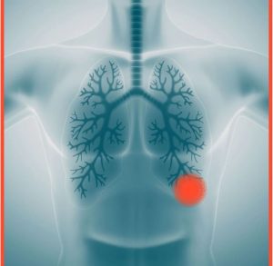 Legionnaires-Disease-Symptoms-Treatments-Prevention