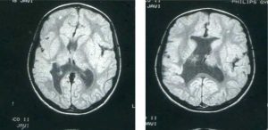 Schizencephaly_Causes_Symptoms_and_Treatments