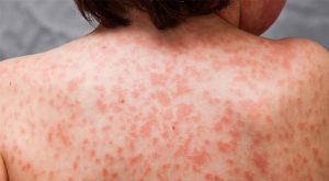 kawasaki_disease_symptoms_usahealtharticles kawasaki_disease_symptoms_usahealtharticles