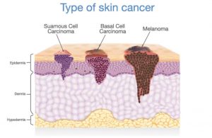 Basal_Cell_Carcinoma_and_Squamous_Cell_Carcinoma type of skin cancer - Basal_Cell_Carcinoma_and_Squamous_Cell_Carcinoma