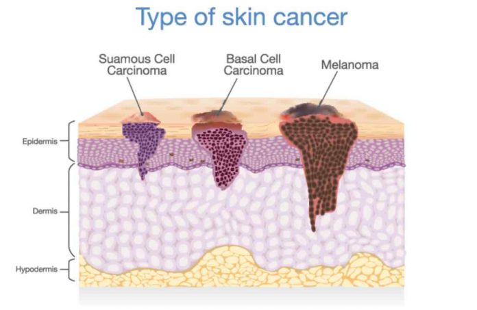 What is the difference between Basal Cell Carcinoma and Squamous Cell ...