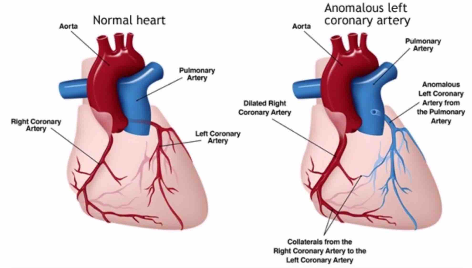 Anomalous_Coronary_Artery_ACA
