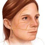 Get to know Ramsay Hunt Syndrome, a Paralyzed Face Disease Ramsay Hunt Syndrome