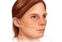 Get to know Ramsay Hunt Syndrome, a Paralyzed Face Disease Ramsay Hunt Syndrome